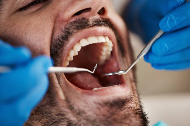 Best Emergency Wisdom Teeth Removal in Fremont, MI